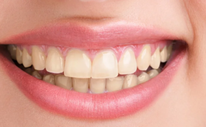 Teeth Cleaning Cost in Aurangabad