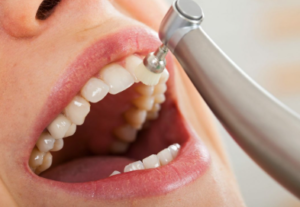 Teeth Cleaning Cost in Clove