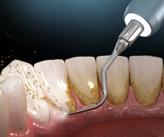 Teeth Cleaning Cost in Germany