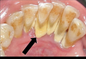 Teeth Cleaning Cost in Kerala