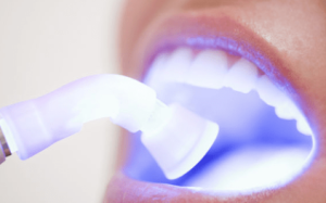 Teeth Cleaning Cost in Kolkata