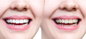 Teeth Cleaning Cost in Mumbai