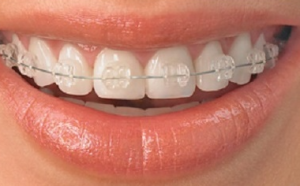 Teeth Cleaning Costs in Bhopal