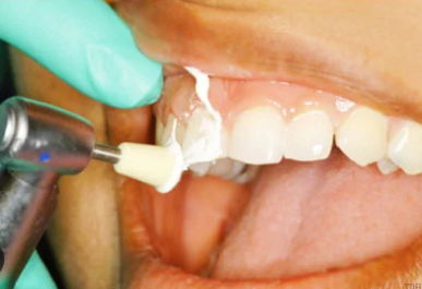 Teeth Cleaning Costs in Ludhiana