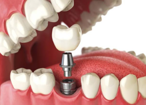 Tooth Implant Costs in Davao City