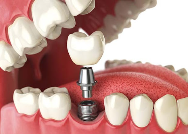 Tooth Implant Costs in Davao City