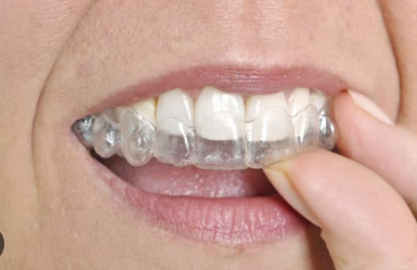 Transparent Braces for Teeth cost