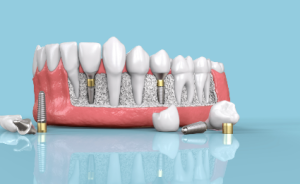 Types of Dental Implants Cost