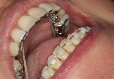 braces on front 6 teeth only cost