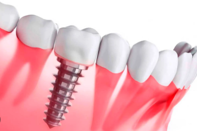 cheap dental implants in dominican republic