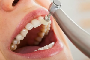 cleaning teeth at dentist price in south africa