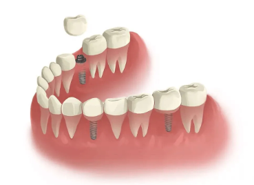 dental implants cost in botswana