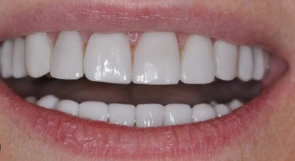 Dental Veneers Cost in Pakistan