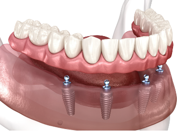 implant supported dentures cost