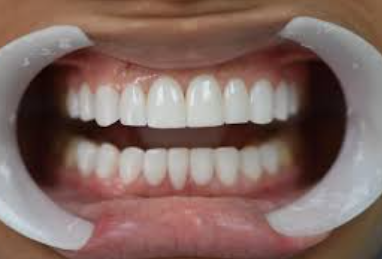 veneers in dominican republic under $2500