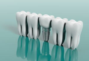 1-Day Dental Implants in California