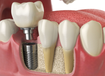 $1000 Dental Implants in New Jersey