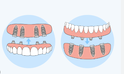 All-On-4 Dental Implants Cost in Colorado Springs