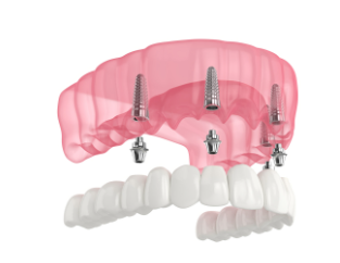 All-On-4 Dental Implants Cost in Las Vegas