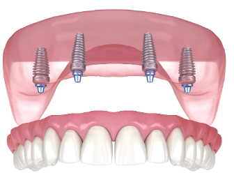 All-On-4 Dental Implants Cost in Phoenix