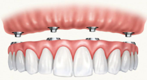 Cost of Dental Implants in Placerville CA