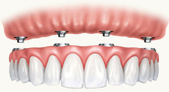 Cost of Dental Implants in Placerville CA