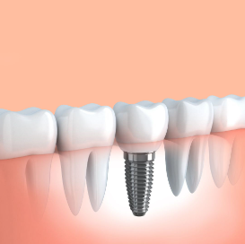 Cost of Dental Implants in Santa Barbara