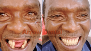 Cost of Teeth Cleaning in Kenya