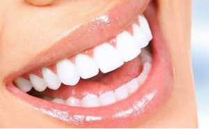 Cost of Teeth Cleaning in Perth