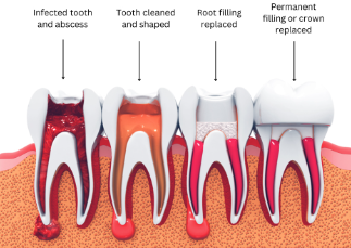 Cost of a Dental Cap After Root Canal