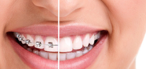 Damon Braces Cost in India