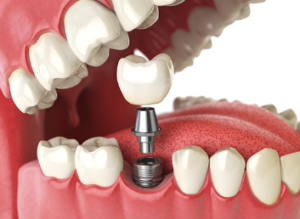 Dental Implant Costs in Massachusetts