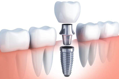 Dental Implant Costs in Michigan