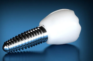 Dental Implant Screw Cost