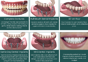 Dental Implants Cost for Whole Mouth