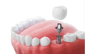 Dental Implants Thailand Cost