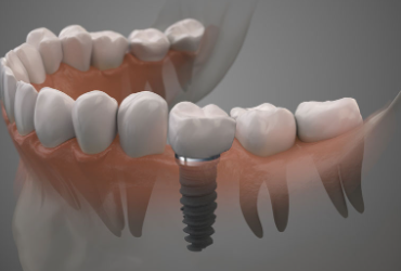 Nuset Dental Implant Cost