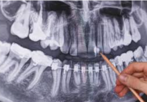 Panoramic Dental X-Ray Cost in the UK