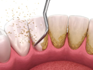 Periodontal Cleaning Cost Without Insurance