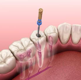 Root Canal Treatment Cost in Kerala