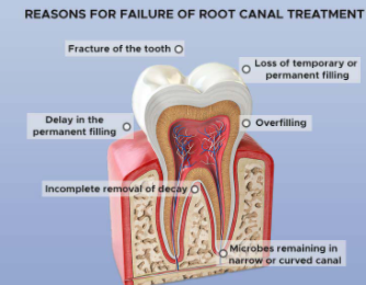 Root Canal Treatment and Capping Cost