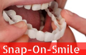 Snap-On Smile Cost in India