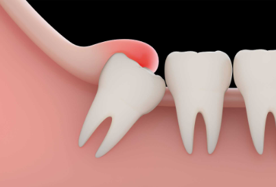 Surrounding Teeth Pain After Tooth Extraction