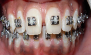 Teeth Braces Cost in Patna