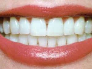 Teeth Whitening Cost in Pune