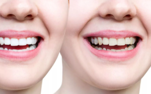 Teeth Whitening Cost in Trivandrum