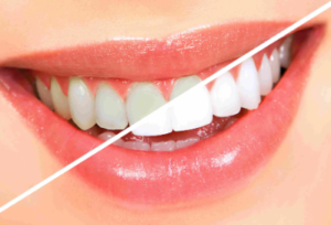 Teeth Whitening Prices in Ireland