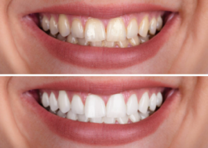 Teeth Whitening Treatment Cost