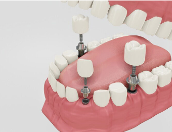 Tooth Implant Cost in Poland