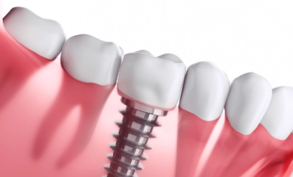 Turning Point Dental Implants Cost